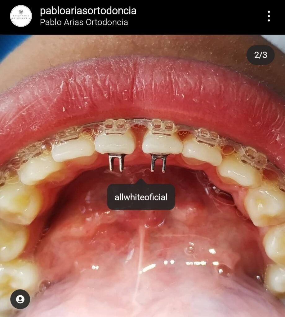 Spikes (Trampa Lingual) AllWhite